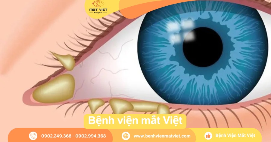 Hình: Màng nhầy trắng – ghèn mắt.