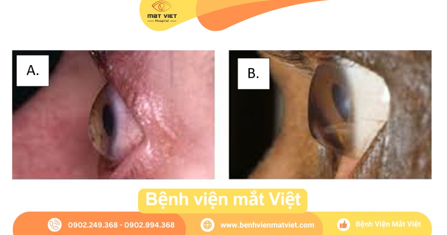 Hình: Thoái hóa rìa giác mạc trong suốt:Giai đoạn sớm – B. Giai đoạn tiến triển