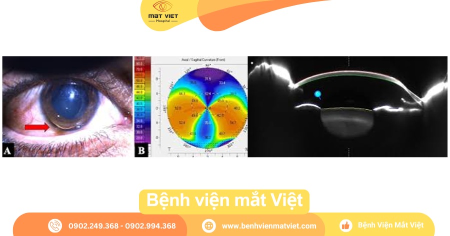 Giác mạc, bản đồ giác mạc và chụp cắt lớp giác mạc trong bệnh lý PMD