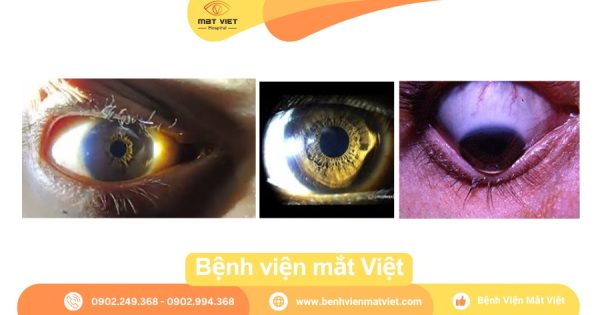 Dấu hiệu Rizutti và Munson