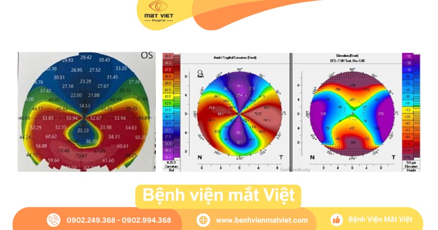 Bản đồ giác mạc trong PMD.