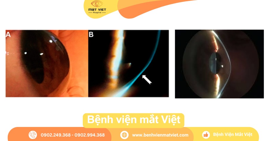 A.B.Giác mạc PMD“bụng bia” -  C. Giác mạc chóp phình dãn ở trung tâm.