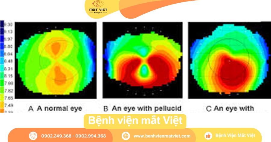 Bản đồ giác mạc: Loạn thị: Bình thường - PMD và Giác mạc chóp.