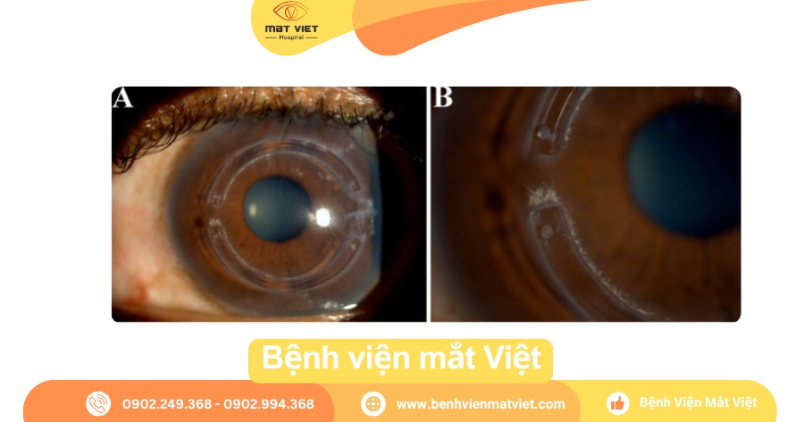 Cấy ghép giác mạc Intacs
