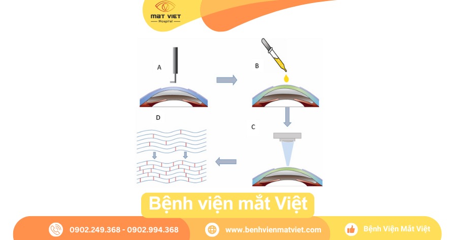Điều trị Cross – Linking (CXL).