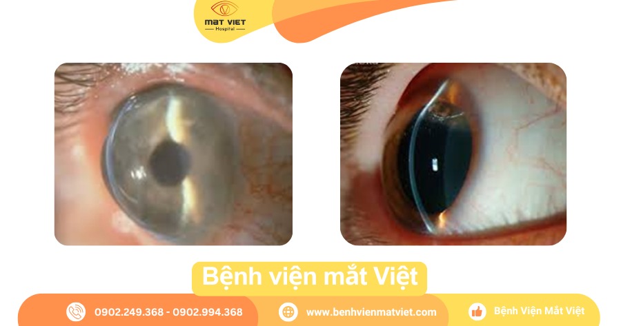 Thoái hóa rìa giác mạc trong suốt (PMD)