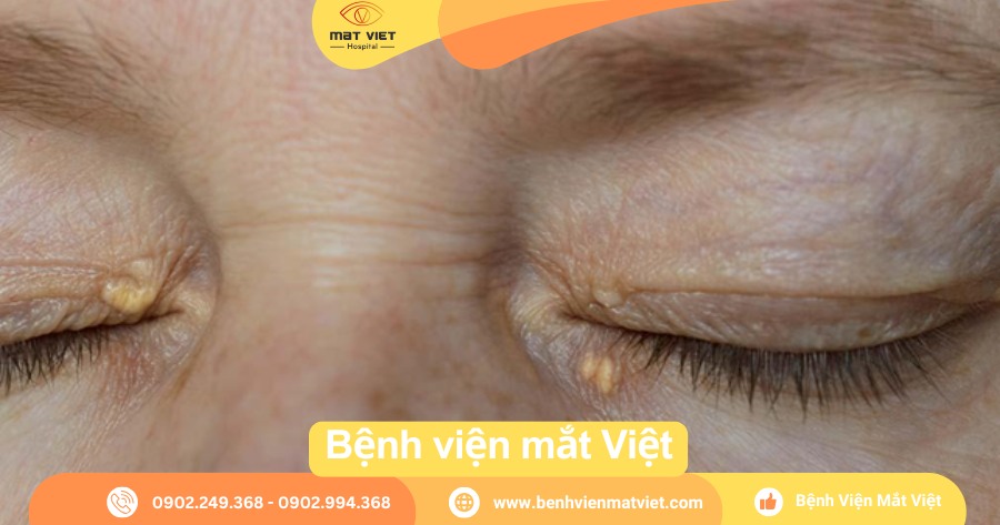 Hình 1: U vàng mi mắt, đặc trưng xuất hiện ở góc trong da mi trên và/hoặc dưới.