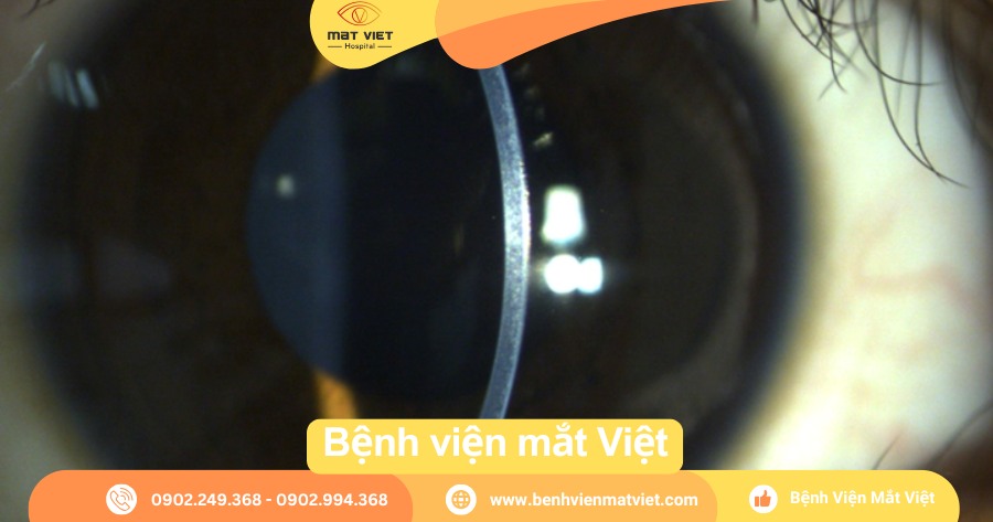 Hình ảnh giác mạc (Nguồn: Bệnh viện Mắt Việt)